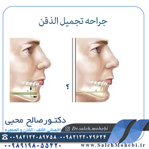 جراحه-تجمیل-الذقن
