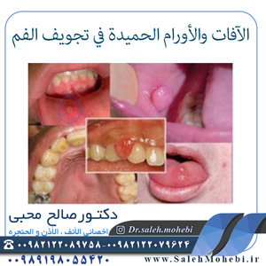 الآفات والأورام الحميدة في تجويف الفم