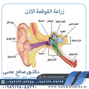 زراعة-القوقعة-الاذن