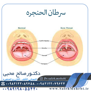 سرطان حنجره