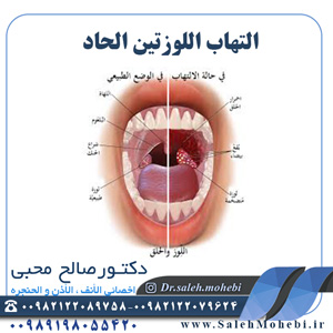التهاب اللوزتين الحاد      