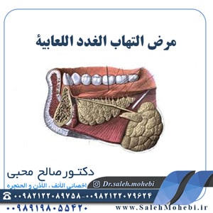 مرض التهاب الغدد اللعابية