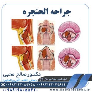 جراحه الحنجره