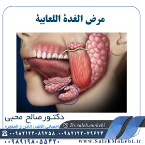 مرض الغده اللعابیه