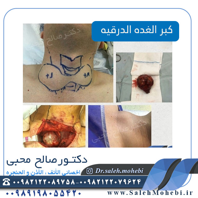 هل الغدة الدرقية يمكن أن توثر علی السمع؟      