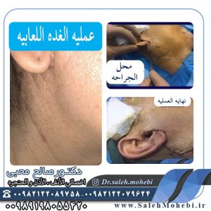 علاج ورم الغدة اللعابية مع الجراحة