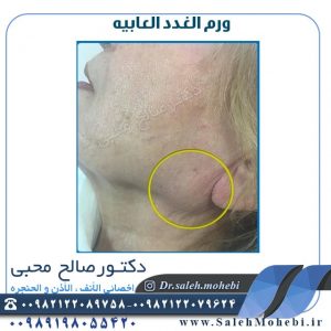 علاج ورم الغدة اللعابية مع الجراحة