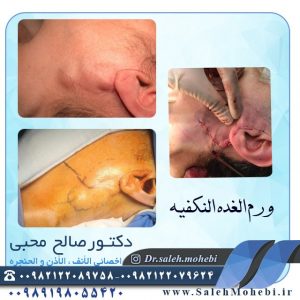 جراحة عوده ورم النكفية                        