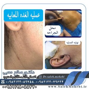  هل سرطان الغدة اللعابية یتعالج؟                                 