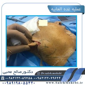 مشاکل الغده اللعابیه الاکثر شیوعا و علاجها