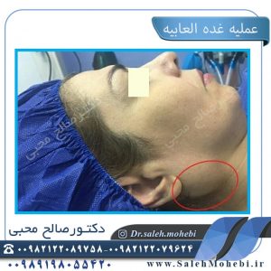 مشاکل الغده اللعابیه الاکثر شیوعا و علاجها