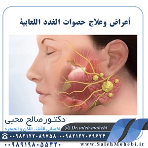 أعراض وعلاج حصوات الغدد اللعابية