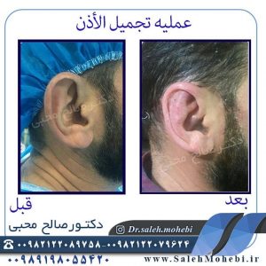الرعایه  بعد الجراحه التجمیلیه الاذن