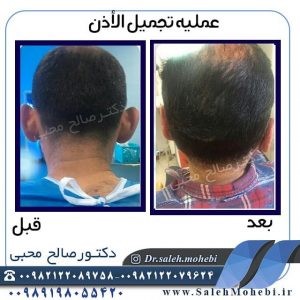 الرعایه  بعد الجراحه التجمیلیه الاذن
