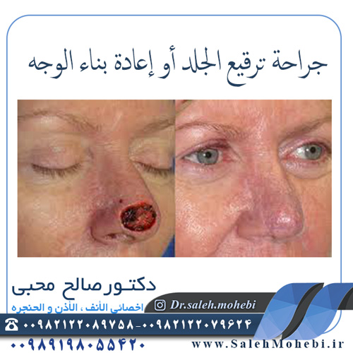 جراحة ترقیع الجلد أو إعادة بناء الوجه