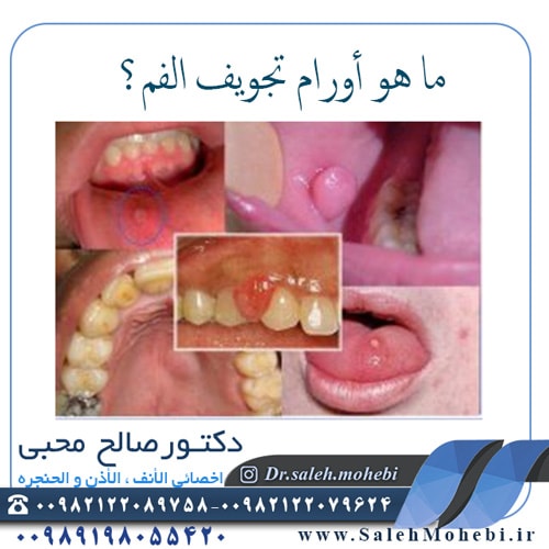 ما هو أورام تجويف الفم؟