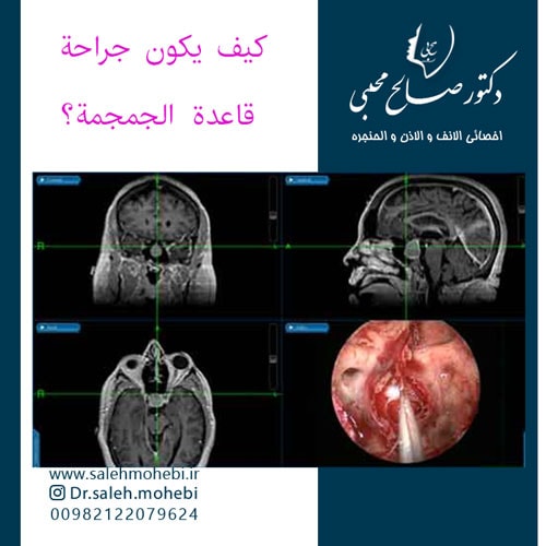 کیف یکون جراحة قاعدة الجمجمة؟