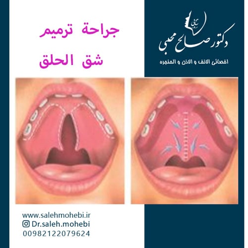 جراحة ترمیم شق الحلق