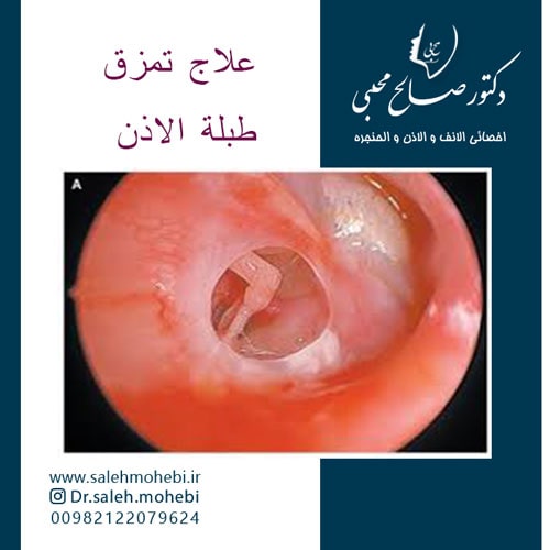 علاج تمزق طبلة الاذن